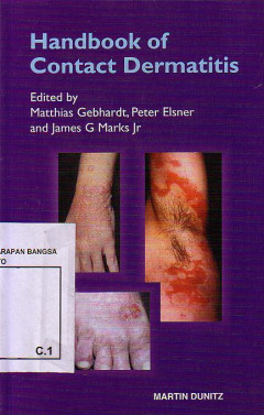 Handbook Of Contact Dermatitis
